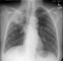tuberculosis
